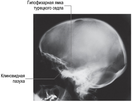 Файл:Придаточные пазухи носа. Боковая рентгенограмма черепа.jpg