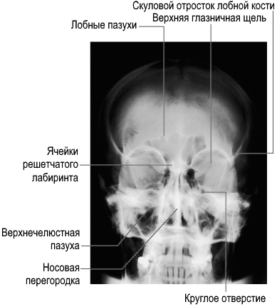 Файл:Околоносовые синусы (пазухи). Заднепередняя рентгенограмма черепа.jpg