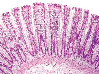 Стенка толстой кишки Нормальная слизистая толстой кишки. Оптическая микроскопия. Гистологический препарат, полученный при биопсии. Поверхность слизистой (верх рисунка), образованная столбчатым эпителием, имеет параллельно расположенные крипты. Их выходы открыты в полость толстой кишки. Собственная пластинка слизистой оболочки состоит из соединительнотканных элементов, окутывающих крипты и простирающихся от поверхности эпителия до гладкомышечных клеток собственной пластинки (низ рисунка).
