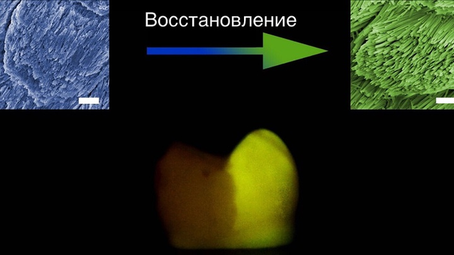 Файл:Зуб, частично покрытый восстанавливающим составом; сверху показано восстановление микроструктуры эмали.png