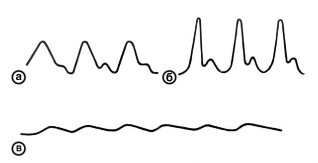 Файл:Сфигмографическое отображение высокого скорого (6) и малого медленного (в) пульса в сравнении с нормальным пульсом (а).jpg