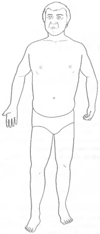 Файл:Форма тела, указывающая на Избыточное состояние Желудка.png